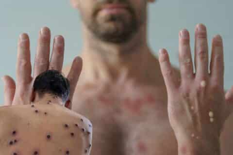 MPox no DF há 80 doses de vacina e aplicação segue critérios técnicos definidos pela Saúde