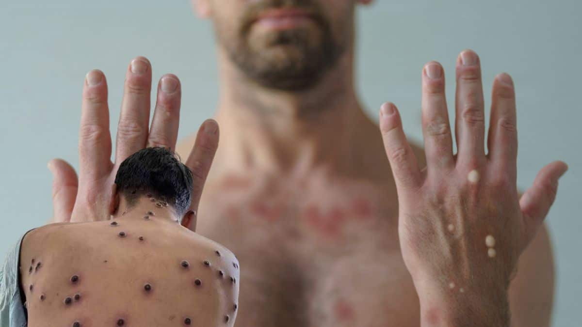 MPox no DF há 80 doses de vacina e aplicação segue critérios técnicos definidos pela Saúde